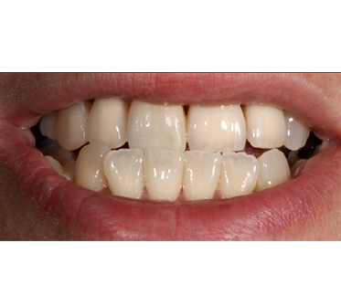 After - rosewood-dental
